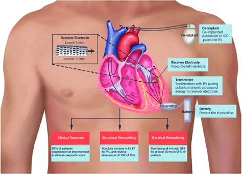 lv pacing meaning|left ventricular pacing therapy.